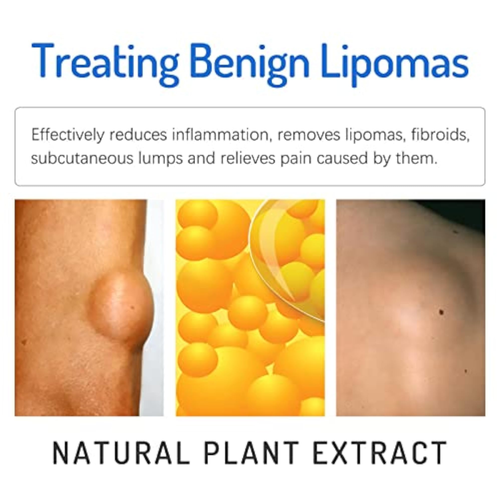 LOOM TREE 20g Lipoma Removal Cream, Herbal Care Cream